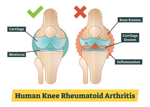 Arthritis and Grip: How Arthritis Affects Grip, How to Strengthen Grip