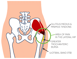 Gluteal Tendinopathy