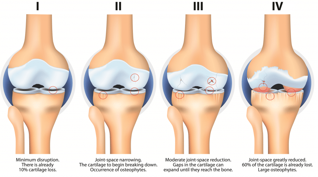 Knee Osteoarthritis