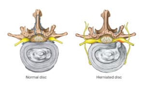 disc bulge and herniation