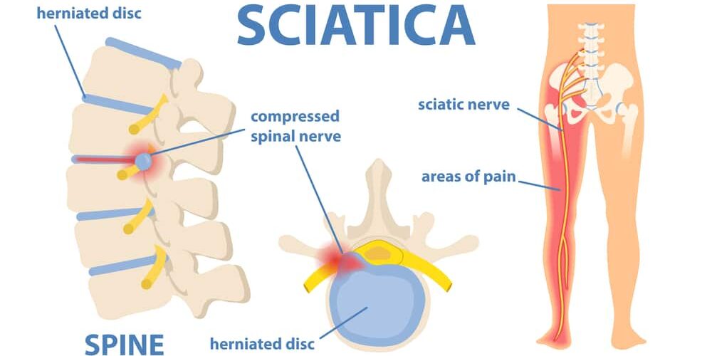How Does Physiotherapy Help in Managing Sciatica Pain? How Does Physiotherapy Help in Managing Sciatica Pain?