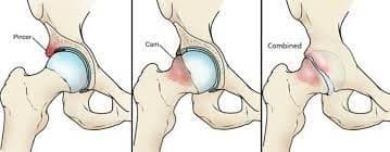 Hip impingement.