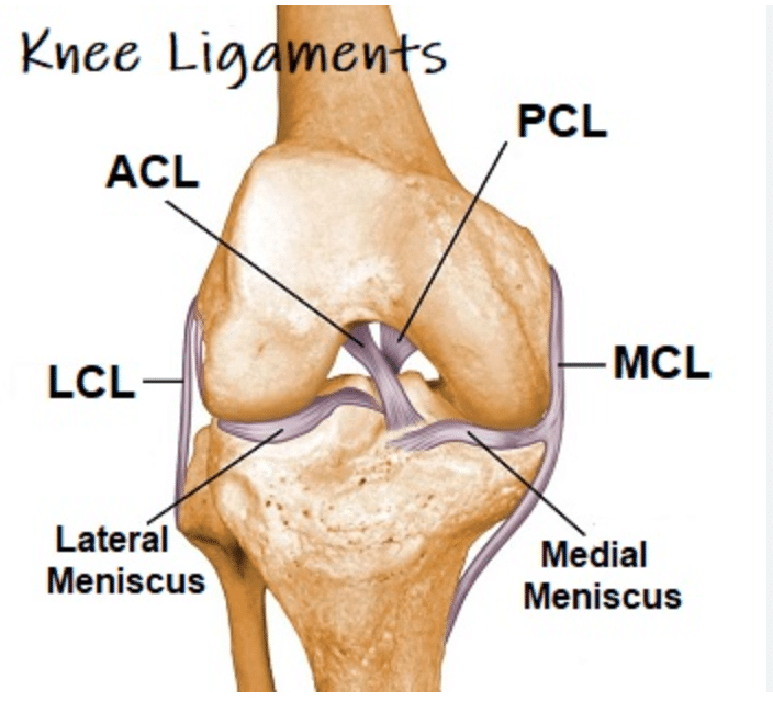 Diagram of an ACL tear in the knee - ACL physio Baulkham Hills