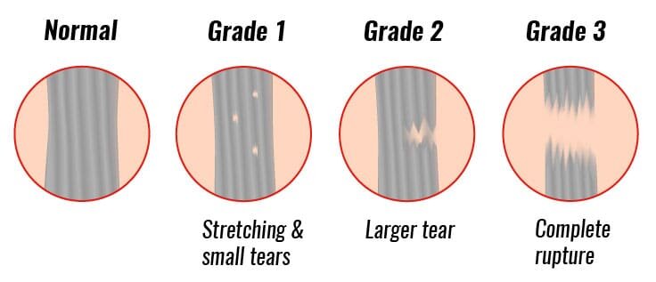 Grades of a ligament sprain explained by our Baulkham Hills physio team